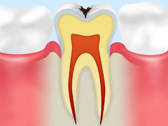 C1～エナメル質の虫歯～